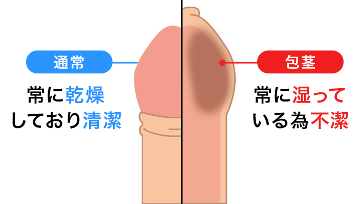 包茎手術について | 包茎手術の東京ノーストクリニック【公式】